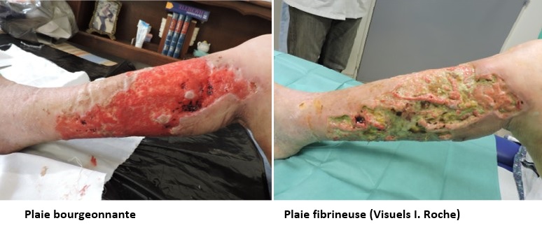 Plaie traumatique dans un contexte d’insuffisance veineuse chronique : détersion prise en charge avec AQUACEL® Extra™-7 J0 (jour de la mise en place d’ AQUACEL® Extra™)-10 et J21 (Visuel Isabelle ROCHE, Infirmière – CH Antibes) 