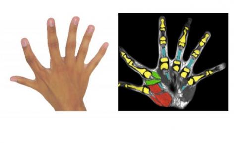 La polydactylie, ou 6 doigts par main, c’est aussi la présence de muscles supplémentaires et des capacités de manipulation augmentées La polydactylie, ou 6 doigts par main, c’est aussi la présence de muscles supplémentaires et des capacités de manipulation augmentées
