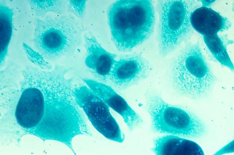 La perte de protéines de surface cellulaire -et de certains phospholipides- induit la perte de l’identité cellulaireet la migration des cellules épithéliales ce qui peut entraîner la fibrose ou le cancer (Visuel Adobe Stock 111509561). La perte de protéines de surface cellulaire -et de certains phospholipides- induit la perte de l’identité cellulaireet la migration des cellules épithéliales ce qui peut entraîner la fibrose ou le cancer (Visuel Adobe Stock 111509561).