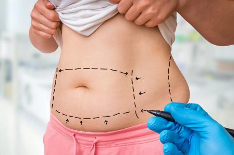 Après une abdominoplastie, ou chirurgie plastique de l’abdomen, les seuls résultats cosmétiques ne constituent pas le seul facteur ayant une incidence sur la satisfaction des patients Après une abdominoplastie, ou chirurgie plastique de l’abdomen, les seuls résultats cosmétiques ne constituent pas le seul facteur ayant une incidence sur la satisfaction des patients