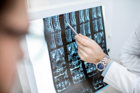 Un nouveau nanobiomatériau appelé hydroxyde double lamellaire (LDH) contribue à inhiber l'environnement inflammatoire entourant les lésions de la moelle épinière, favorisant ainsi la régénération des neurones et la reconstruction du circuit neural dans la colonne vertébrale (Adobe Stock 247792582) Un nouveau nanobiomatériau appelé hydroxyde double lamellaire (LDH) contribue à inhiber l'environnement inflammatoire entourant les lésions de la moelle épinière, favorisant ainsi la régénération des neurones et la reconstruction du circuit neural dans la colonne vertébrale (Adobe Stock 247792582)