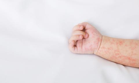 Ce nouveau médicament biologique s’appelle le Dupilumab (Visuel Adobe Stock 266372512) Ce nouveau médicament biologique s’appelle le Dupilumab (Visuel Adobe Stock 266372512)