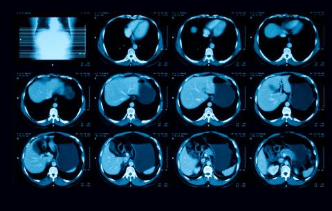 Cette étude documente une nouvelle option thérapeutique prometteuse pour les patients atteints d'un cancer urothélial avancé (Visuel Adobe Stock 308601417) Cette étude documente une nouvelle option thérapeutique prometteuse pour les patients atteints d'un cancer urothélial avancé (Visuel Adobe Stock 308601417)