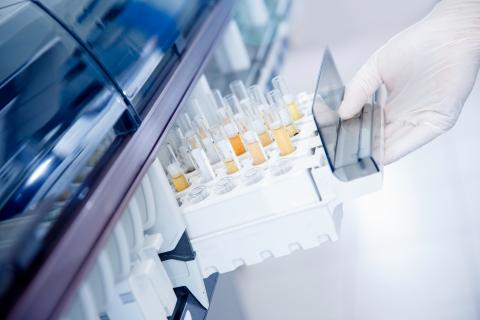 C'est une option moins invasive et plus fiable, basée sur le score de risque de spermine mesuré par un simple test d’urine (Visuel Adobe Stock 334065984) C'est une option moins invasive et plus fiable, basée sur le score de risque de spermine mesuré par un simple test d’urine (Visuel Adobe Stock 334065984)
