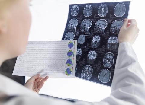 C'est un nouveau candidat médicament pour le traitement de l'épilepsie du lobe temporal (ETL), l'un des types d'épilepsie les plus courants dans le monde (Visuel Adobe Stock 503671525) C'est un nouveau candidat médicament pour le traitement de l'épilepsie du lobe temporal (ETL), l'un des types d'épilepsie les plus courants dans le monde (Visuel Adobe Stock 503671525)