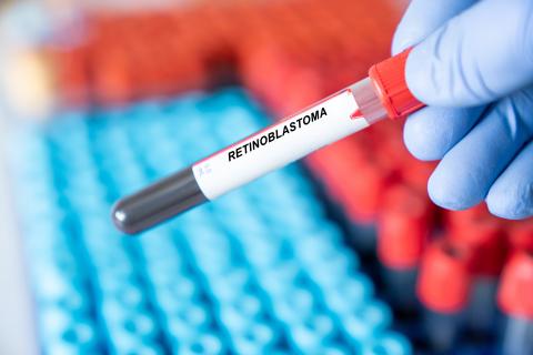 Cette équipe du Children’s Hospital Los Angeles, s’apprête à lancer la toute première étude internationale sur le recours à la biopsie liquide pour le diagnostic, la surveillance et l’évaluation de la réponse au traitement du rétinoblastome (Visuel Adobe Stock 585322164) Cette équipe du Children’s Hospital Los Angeles, s’apprête à lancer la toute première étude internationale sur le recours à la biopsie liquide pour le diagnostic, la surveillance et l’évaluation de la réponse au traitement du rétinoblastome (Visuel Adobe Stock 585322164)