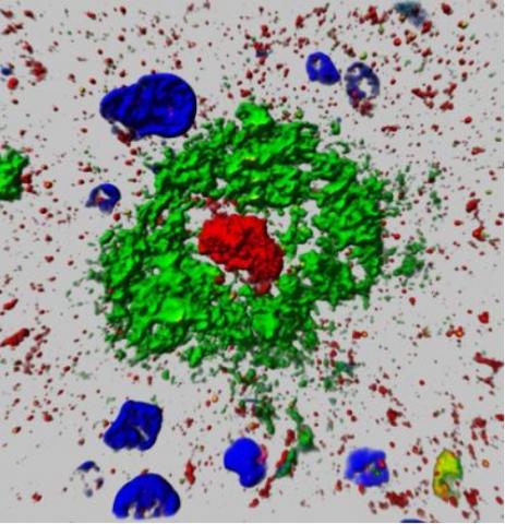 La protéine s'accumule ou s'agrège de manière caractéristique au centre de la plaque chez les patients atteints, un peu comme le jaune d'un œuf. La protéine s'accumule ou s'agrège de manière caractéristique au centre de la plaque chez les patients atteints, un peu comme le jaune d'un œuf.