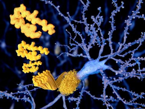 Alzheimer : L’altération du processus de glycosylation de la protéine précurseur entraîne un excès d’amyloïde (Visuel AdobeStock_103208979) Alzheimer : L’altération du processus de glycosylation de la protéine précurseur entraîne un excès d’amyloïde (Visuel AdobeStock_103208979)