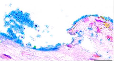 La combinaison de bétadine et de gel colloïdal d'argent est le cocktail le plus efficace pour éliminer les bactéries responsables des infections de plaies et la formation de biofilms (Visuel Fotolia) La combinaison de bétadine et de gel colloïdal d'argent est le cocktail le plus efficace pour éliminer les bactéries responsables des infections de plaies et la formation de biofilms (Visuel Fotolia)