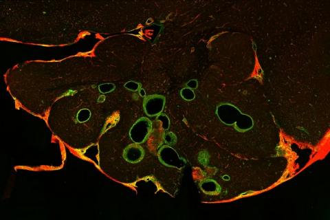 Les malformations caverneuses cérébrales (CCM), également appelées angiomes caverneux ou cavernomes, sont des lésions vasculaires sur les vaisseaux sanguins du cerveau (Visuel Joppe Oldenburg) Les malformations caverneuses cérébrales (CCM), également appelées angiomes caverneux ou cavernomes, sont des lésions vasculaires sur les vaisseaux sanguins du cerveau (Visuel Joppe Oldenburg)