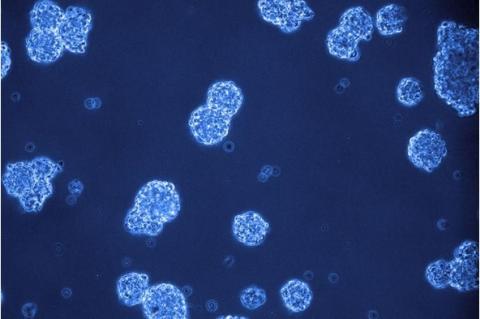 Un médicament déjà connu pour agir sur les cellules de la leucémie en interagissant avec la ménine, une protéine qui régule l'expression des gènes, se révèle ici efficace à éliminer les cellules de gliome Un médicament déjà connu pour agir sur les cellules de la leucémie en interagissant avec la ménine, une protéine qui régule l'expression des gènes, se révèle ici efficace à éliminer les cellules de gliome