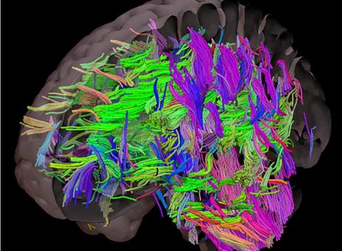 Des tractus de substance blanche sont endommagés chez les personnes présentant des risques cardiovasculaires incontrôlés comme l'obésité (Visuel University of Sheffield) Des tractus de substance blanche sont endommagés chez les personnes présentant des risques cardiovasculaires incontrôlés comme l'obésité (Visuel University of Sheffield)