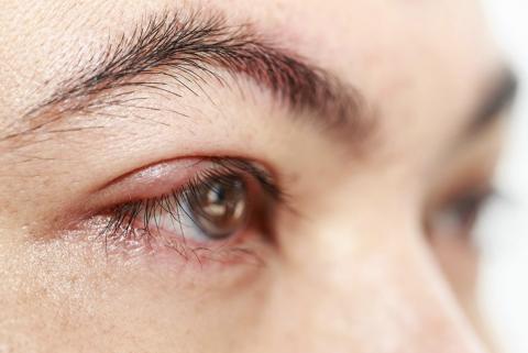 Le chalazion est une sorte de bouton localisé au niveau de la paupière, qui provoque généralement un œdème, des rougeurs voire des douleurs Le chalazion est une sorte de bouton localisé au niveau de la paupière, qui provoque généralement un œdème, des rougeurs voire des douleurs