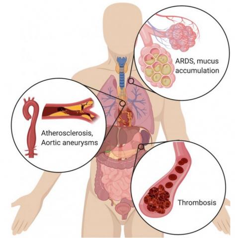 Des cellules immunitaires hyperactives, des neutrophiles, semblent, avec leurs « pièges extracellulaires » causer le décès dans la maladie COVID-19 Des cellules immunitaires hyperactives, des neutrophiles, semblent, avec leurs « pièges extracellulaires » causer le décès dans la maladie COVID-19
