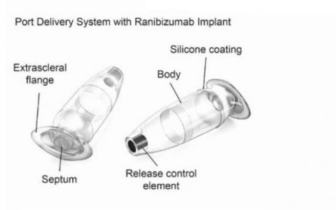 Ce dispositif de réservoir de médicament implantable va permettre de supprimer en toute sécurité les injections chez les personnes atteintes de dégénérescence maculaire liée à l’âge Ce dispositif de réservoir de médicament implantable va permettre de supprimer en toute sécurité les injections chez les personnes atteintes de dégénérescence maculaire liée à l’âge