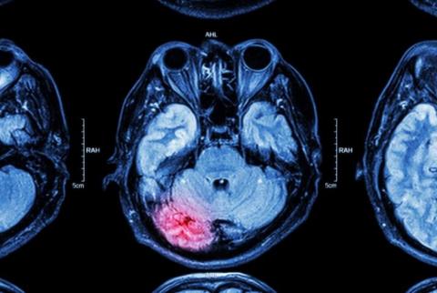 L'intervention consiste à supprimer les nouveaux neurones formés à la suite d'une crise. L'intervention consiste à supprimer les nouveaux neurones formés à la suite d'une crise.