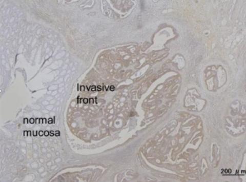 La nouvelle technique révèle une motilité cellulaire significativement plus élevée dans la zone tumorale que dans la muqueuse normale du côlon (Visuel Nature Communications) La nouvelle technique révèle une motilité cellulaire significativement plus élevée dans la zone tumorale que dans la muqueuse normale du côlon (Visuel Nature Communications)