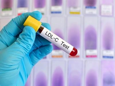 Il existe un lien étroit entre les niveaux de cholestérol non HDL et le risque de maladie cardiovasculaire chez les personnes de moins de 45 ans Il existe un lien étroit entre les niveaux de cholestérol non HDL et le risque de maladie cardiovasculaire chez les personnes de moins de 45 ans