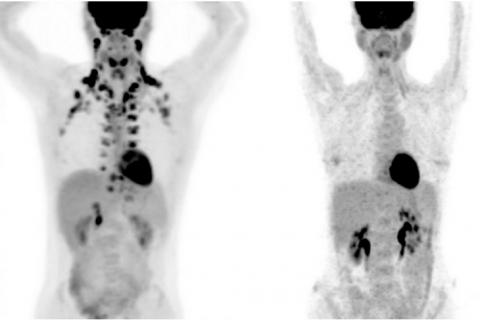 Présenter de la graisse brune en plus forte quantité, est associé à un risque considérablement diminué de maladies cardiaques et métaboliques (Visuel MSKCC radiologists Andreas G. Wibmer and Heiko Schöder.) Présenter de la graisse brune en plus forte quantité, est associé à un risque considérablement diminué de maladies cardiaques et métaboliques (Visuel MSKCC radiologists Andreas G. Wibmer and Heiko Schöder.)