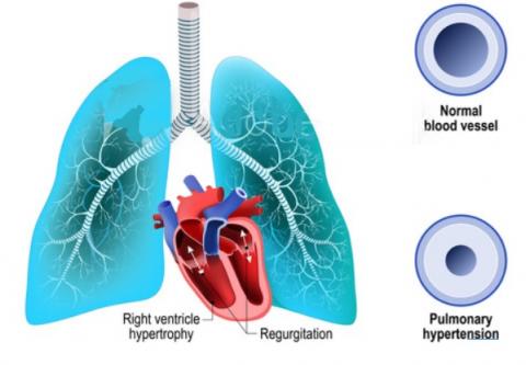 Des bactéries intestinales spécifiques peuvent être associées à une hypertension artérielle pulmonaire Des bactéries intestinales spécifiques peuvent être associées à une hypertension artérielle pulmonaire