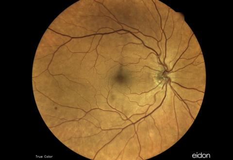 La découverte de ce nouveau mode de détection non invasif pourrait conduire à un processus de dépistage simple où le risque d'infarctus du myocarde pourrait être évalué à l’aide d’un simple test oculaire de routine (Visuel Fotolia) La découverte de ce nouveau mode de détection non invasif pourrait conduire à un processus de dépistage simple où le risque d'infarctus du myocarde pourrait être évalué à l’aide d’un simple test oculaire de routine (Visuel Fotolia)