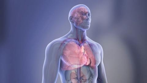 Plus de 40% des adultes sans maladie cardiaque connue présentent des dépôts graisseux dans les artères, ce qui suggère un certain degré d'athérosclérose et un risque accru de maladie et d’événement cardiovasculaire (Visuel AHA) Plus de 40% des adultes sans maladie cardiaque connue présentent des dépôts graisseux dans les artères, ce qui suggère un certain degré d'athérosclérose et un risque accru de maladie et d’événement cardiovasculaire (Visuel AHA)