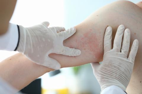 Une nouvelle option révolutionnaire pour les troubles dermatologiques comme le psoriasis (Visuel AdobeStock_321863066) Une nouvelle option révolutionnaire pour les troubles dermatologiques comme le psoriasis (Visuel AdobeStock_321863066)