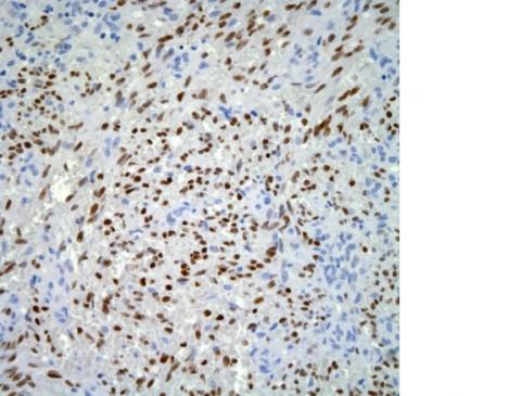 L’inhibiteur de point de contrôle va permettre ainsi au système immunitaire de lutter plus efficacement contre les cellules tumorales L’inhibiteur de point de contrôle va permettre ainsi au système immunitaire de lutter plus efficacement contre les cellules tumorales