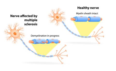 Epuiser la protéine reeline pourrait protéger contre plusieurs conditions caractérisées par une inflammation chronique (visuel CDC) Epuiser la protéine reeline pourrait protéger contre plusieurs conditions caractérisées par une inflammation chronique (visuel CDC)