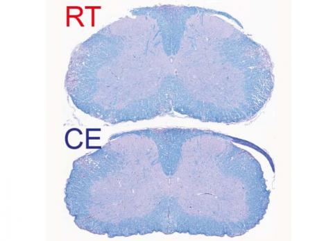 Les lésions démyélinisées apparaissent réduites en cas d’exposition au froid (EC sur visuel : exposed to cold) vs à température ambiante (RT : room temperature) (Visuel UNIGE - Laboratoires Trajkovski & Merkler /Métabolisme Cellulaire). Les lésions démyélinisées apparaissent réduites en cas d’exposition au froid (EC sur visuel : exposed to cold) vs à température ambiante (RT : room temperature) (Visuel UNIGE - Laboratoires Trajkovski & Merkler /Métabolisme Cellulaire).