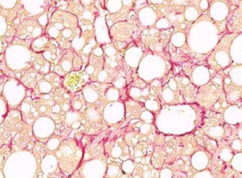 Comprendre les mécanismes cellulaires en cause dans la progression de la stéatose à la stéatohépatite non alcoolique (Visuel Helmholtz Zentrum München / Anne Loft) Comprendre les mécanismes cellulaires en cause dans la progression de la stéatose à la stéatohépatite non alcoolique (Visuel Helmholtz Zentrum München / Anne Loft)