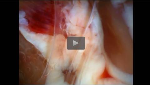 CPLi utilise un faisceau de lumière polarisé pour éclairer le tissu et repérer les nerfs CPLi utilise un faisceau de lumière polarisé pour éclairer le tissu et repérer les nerfs