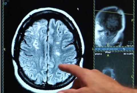 En utilisant des vaisseaux sanguins imprimés en 3D, les scientifiques parviennent à préciser les liens possibles entre le coronavirus et l'AVC (Visuel Fotolia) En utilisant des vaisseaux sanguins imprimés en 3D, les scientifiques parviennent à préciser les liens possibles entre le coronavirus et l'AVC (Visuel Fotolia)