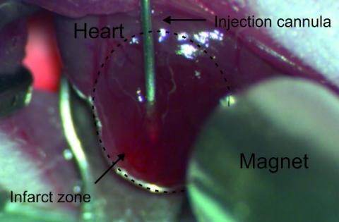 ? Cette méthode innovante consiste à charger les cellules musculaires injectées de nanoparticules magnétiques, à les maintenir en place par un aimant, ce qui permet une meilleure prise de greffe sur le tissu existant. ? Cette méthode innovante consiste à charger les cellules musculaires injectées de nanoparticules magnétiques, à les maintenir en place par un aimant, ce qui permet une meilleure prise de greffe sur le tissu existant.