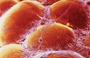La graisse favorise le développement du cancer, mais comment ? La graisse favorise le développement du cancer, mais comment ?