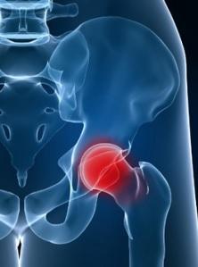 Un traitement prophylactique permet de réduire de 65% le risque de fracture chez les patients âgés sous cortisone Un traitement prophylactique permet de réduire de 65% le risque de fracture chez les patients âgés sous cortisone