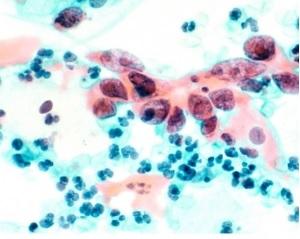Le HPV est responsable de presque tous les cas de cancer du col utérin et de 95% des cancers de l'anus. Le HPV est responsable de presque tous les cas de cancer du col utérin et de 95% des cancers de l'anus.