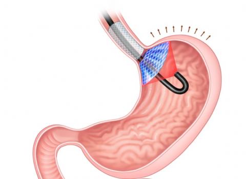 L’implant induit une sensation de satiété en appuyant sur le ventre et, lorsqu'il est activé par un laser l’implant tue les cellules qui produisent l'hormone de la faim, la ghréline (Visuel ACS Applied Materials & Interfaces 2022, DOI: 10.1021/acsami.2c00532). L’implant induit une sensation de satiété en appuyant sur le ventre et, lorsqu'il est activé par un laser l’implant tue les cellules qui produisent l'hormone de la faim, la ghréline (Visuel ACS Applied Materials & Interfaces 2022, DOI: 10.1021/acsami.2c00532).