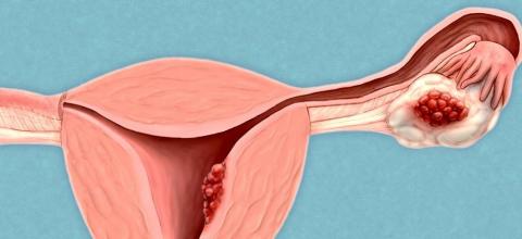 Le cancer de l'ovaire reste l'un des cancers les plus meurtriers car il n'existe aujourd’hui aucune méthode de dépistage et qu'il est souvent diagnostiqué (trop) tardivement. Le cancer de l'ovaire reste l'un des cancers les plus meurtriers car il n'existe aujourd’hui aucune méthode de dépistage et qu'il est souvent diagnostiqué (trop) tardivement.