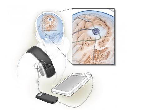 C'est le premier système implanté auto-adaptatif, qui utilise la rétroaction du cerveau lui-même pour affiner sa signalisation. C'est le premier système implanté auto-adaptatif, qui utilise la rétroaction du cerveau lui-même pour affiner sa signalisation.