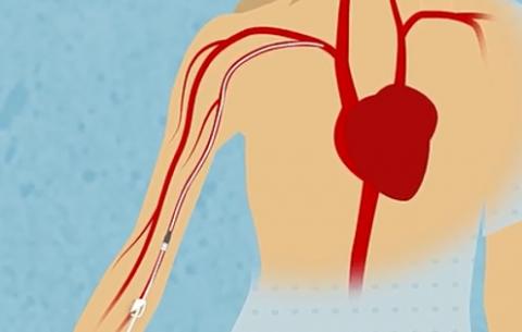 Les dispositifs intraveineux connus sous le nom de PICC (pour peripherally inserted central catheter) devraient être réservés pour une utilisation à long terme Les dispositifs intraveineux connus sous le nom de PICC (pour peripherally inserted central catheter) devraient être réservés pour une utilisation à long terme