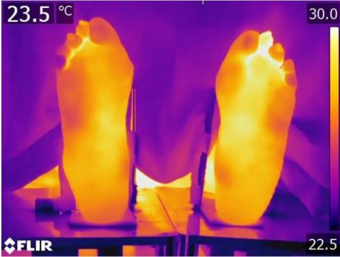 Image thermique montrant les températures dans les différentes régions du pied (Visuel Staffordshire University) Image thermique montrant les températures dans les différentes régions du pied (Visuel Staffordshire University)