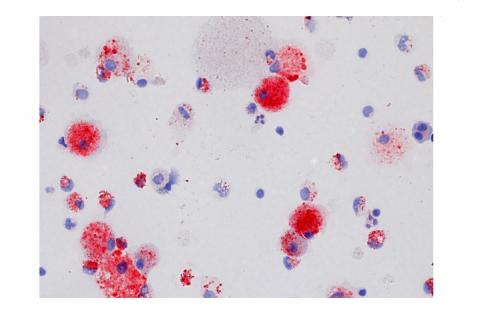 La protéinose alvéolaire pulmonaire est caractérisée par l'accumulation d'une substance composée notamment de cholestérol (en rouge sur visuel) dans les espaces aériens distaux La protéinose alvéolaire pulmonaire est caractérisée par l'accumulation d'une substance composée notamment de cholestérol (en rouge sur visuel) dans les espaces aériens distaux