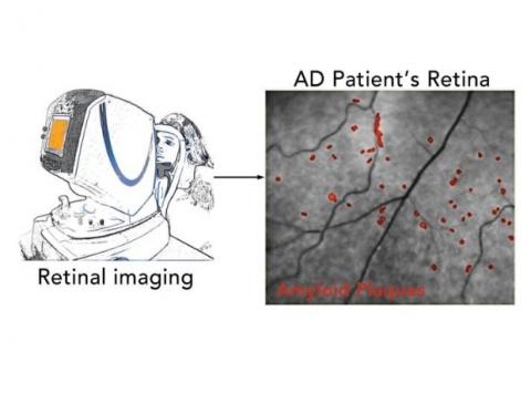 Les patients atteints de la maladie d'Alzheimer présentent des dépôts de protéines ß-protéines amyloïdes (Aβ) situés à la périphérie de la rétine Les patients atteints de la maladie d'Alzheimer présentent des dépôts de protéines ß-protéines amyloïdes (Aβ) situés à la périphérie de la rétine