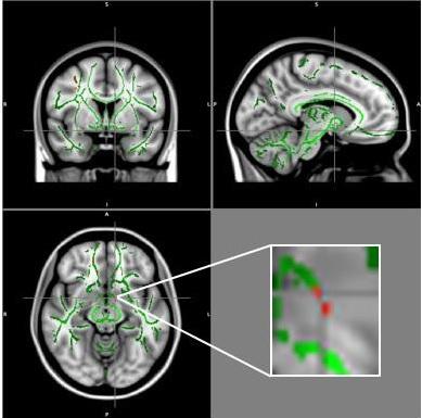 Chez les adolescents obèses, la connectivité est perturbée dans les zones du cerveau impliquées dans la régulation de l'appétit Chez les adolescents obèses, la connectivité est perturbée dans les zones du cerveau impliquées dans la régulation de l'appétit