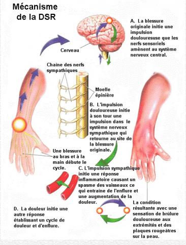 Le syndrome douloureux régional complexe est caractérisé par une douleur handicapante dans un bras ou une jambe Le syndrome douloureux régional complexe est caractérisé par une douleur handicapante dans un bras ou une jambe
