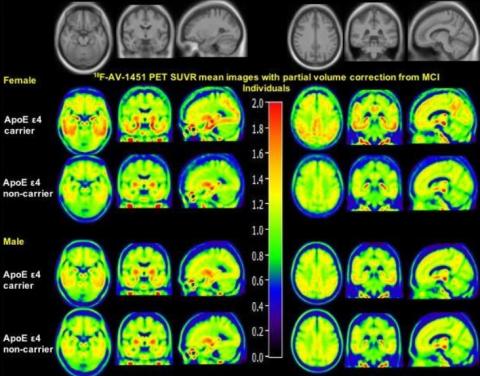C’est la première étude à démontrer que le sexe module l’effet de l’ApoE ε4 sur le dépôt de tau cérébral C’est la première étude à démontrer que le sexe module l’effet de l’ApoE ε4 sur le dépôt de tau cérébral