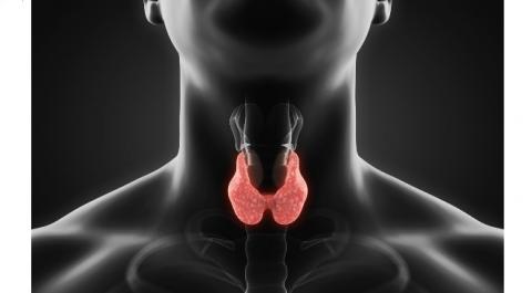 Le traitement excessif des patients atteints d’hypothyroïdie pourrait augmenter leur risque de fibrillation auriculaire (FA) et donc d'accident vasculaire cérébral (AVC) Le traitement excessif des patients atteints d’hypothyroïdie pourrait augmenter leur risque de fibrillation auriculaire (FA) et donc d'accident vasculaire cérébral (AVC)
