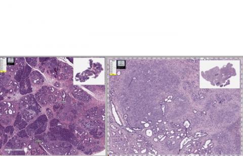 Le mébendazole agit de manière similaire dans le cancer du pancréas en détruisant la structure des cellules cancéreuses et en réduisant l'inflammation (Visuel Tara Williamson).