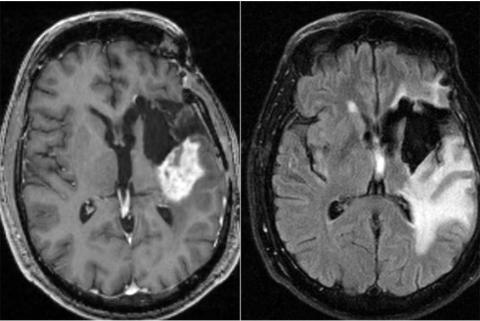 Images IRM du cerveau d'un participant à un essai clinique évaluant la chronothérapie (tumeur représentée par la zone blanche sur l'image de gauche. La grande zone blanche de l'image de droite est un gonflement associé à la tumeur) (Visuel Washington University School of Medicine)